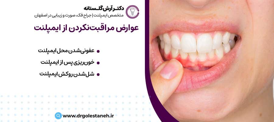 عوارض مراقبت‌نکردن از ایمپلنت پس از کاشت |دکتر آرش گلستانه جراح فک و صورت در اصفهان