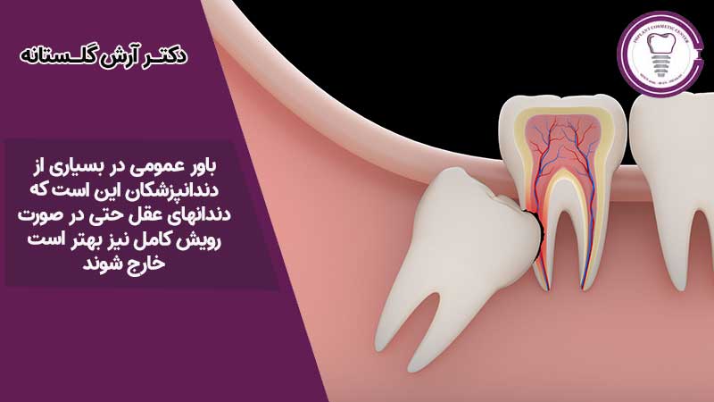 جراحی و کشیدن دندان عقل
