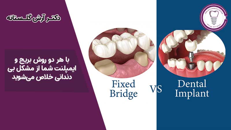 تفاوت بین ایمپلنت و بریج دندان 