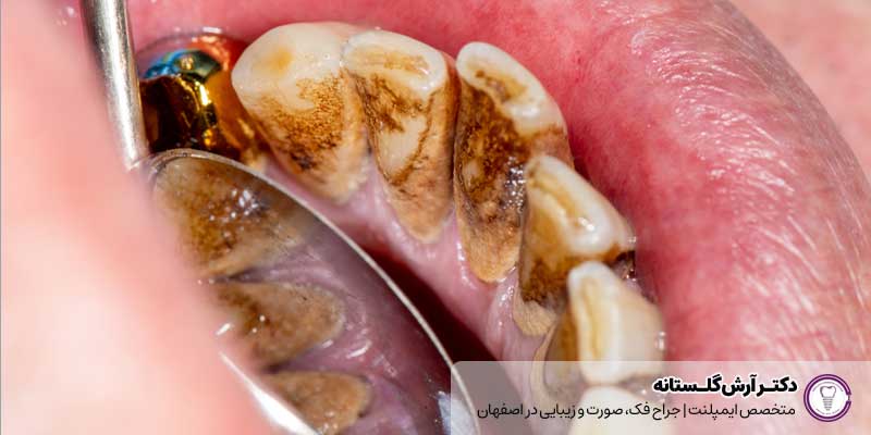 جرم دندان (کَلکولوس دندانی)