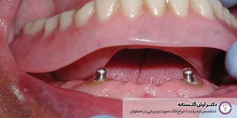 انواع اوردنچر متکی بر  ایمپلنت |دکتر آرش گلستانه جراح فک و صورت در اصفهان