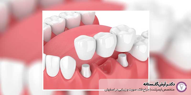 هزینه کاشت دندان بدون ایمپلنت با تکنولوژی جدید در اصفهان