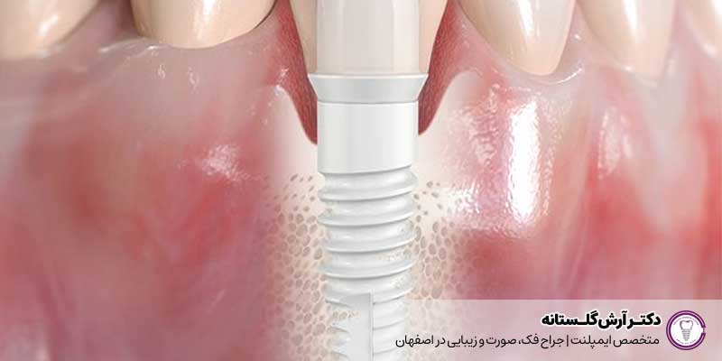 کاشت دندان به روش زیرکونیا
