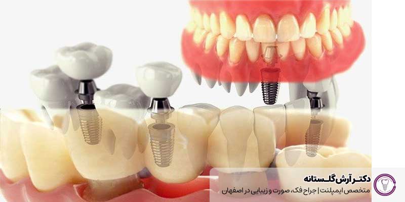 بهترین روش کاشت دندان برای شما کدام است؟