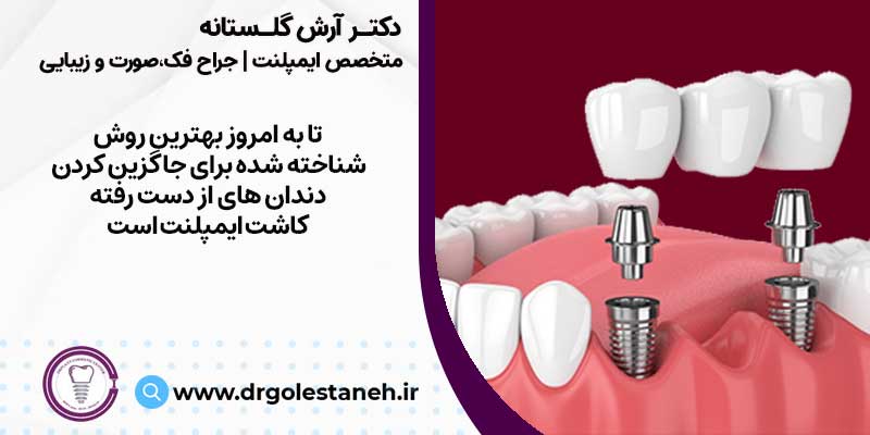کاشت دندان طبیعی با ایمپلنت دندان 