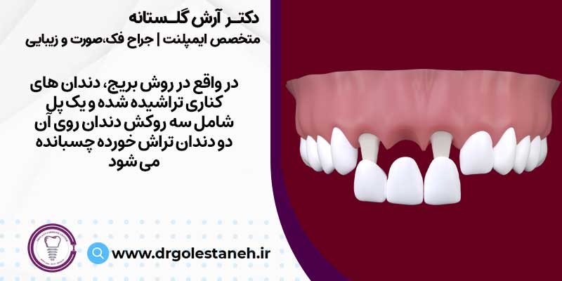 بریج دندان یکی از روش های کاشت دندان بدون ایمپلنت