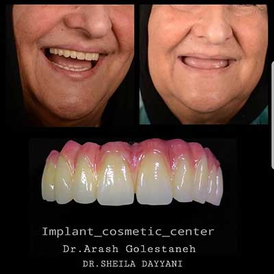 ایمپلنت کامل دندان ها توسط دکتر آرش گلستانه