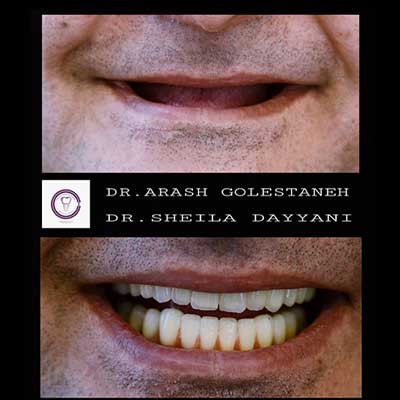 باز آفرینی طرح لبخند توسط دکتر آرش گلستانه