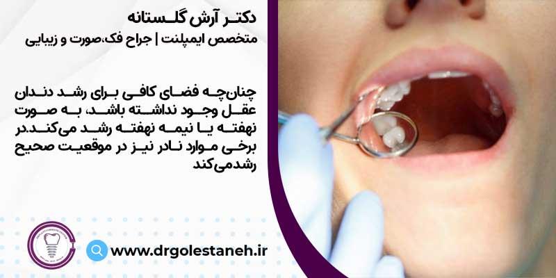 کشیدن دندان عقل در اصفهان