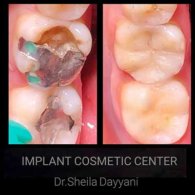 روکش دندان با کامپوزیت و آمالگام توسط دکتر آرش گلستانه