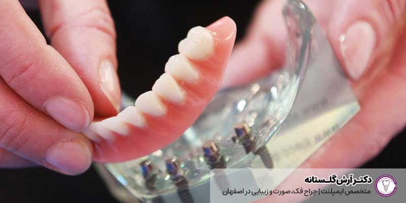 قیمت ایمپلنت کامل دندان در اصفهان