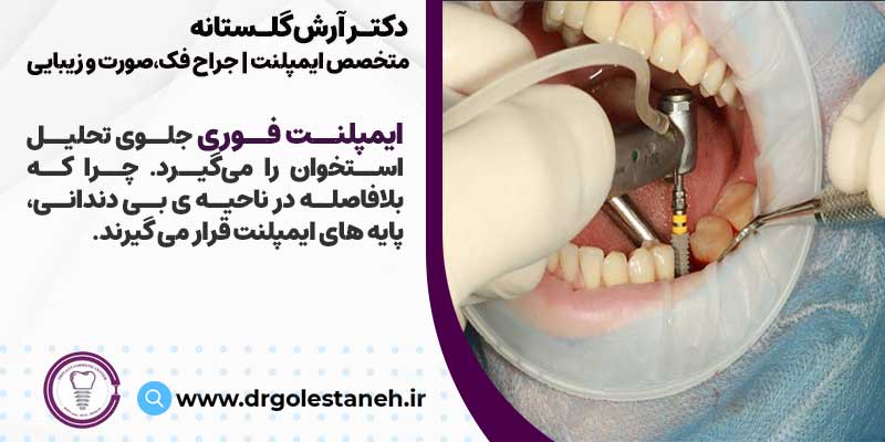 انجام ایمپلنت فوری باعث کاهش هزینه ایمپلنت دندان می شود | دکتر آرش گلستانه متخصص ایمپلنت اصفهان
