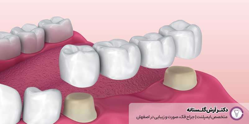 کاشت دندان بدون ایمپلنت در اصفهان
