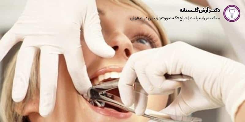 کشیدن دندان عقل پوسیده