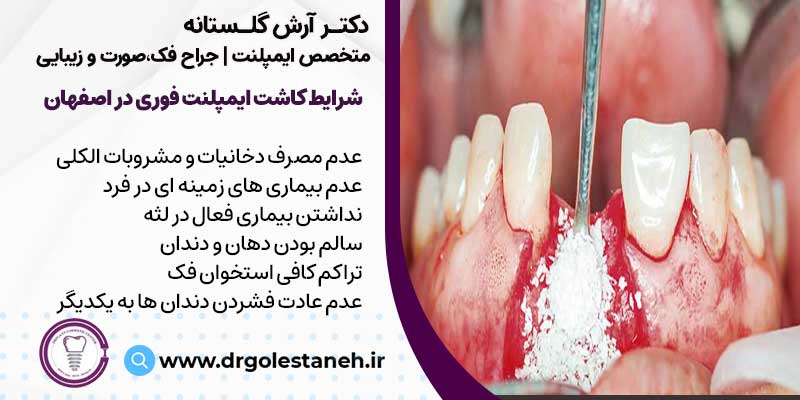 شرایط کاشت ایمپلنت فوری در اصفهان | دکتر آرش گلستانه