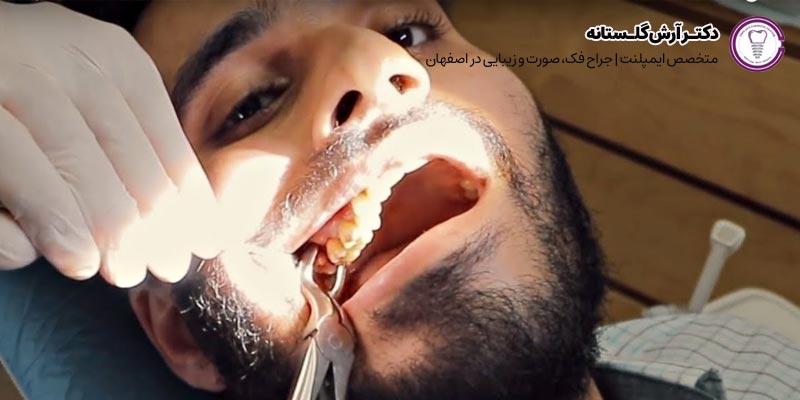 بهترین جراح دندان عقل در اصفهان