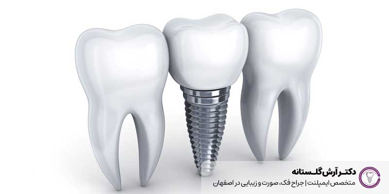 طول عمر ایمپلنت دندان و تاج پروتزی آن چقدر است؟ 