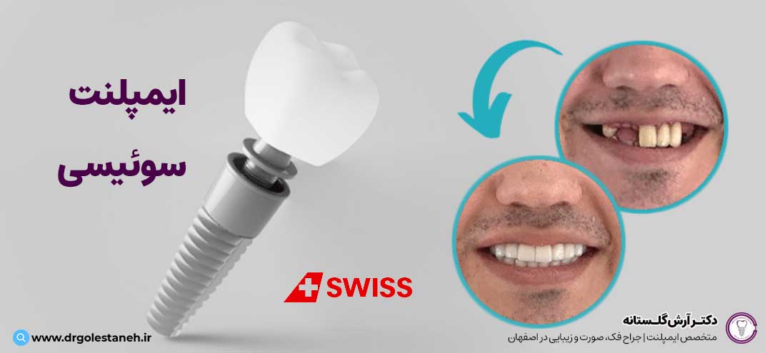 ایمپلنت دندان سوئیسی | دکتر آرش گلستانه متخصص ایمپلنت در اصفهان