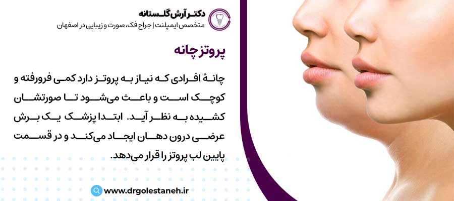 پروتز چانه |دکتر آرش گلستانه جراح فک و صورت در اصفهان