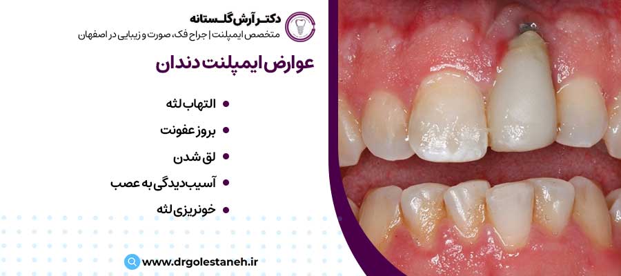 عوارض ایمپلنت دندان |دکتر آرش گلستانه جراح فک و صورت در اصفهان 