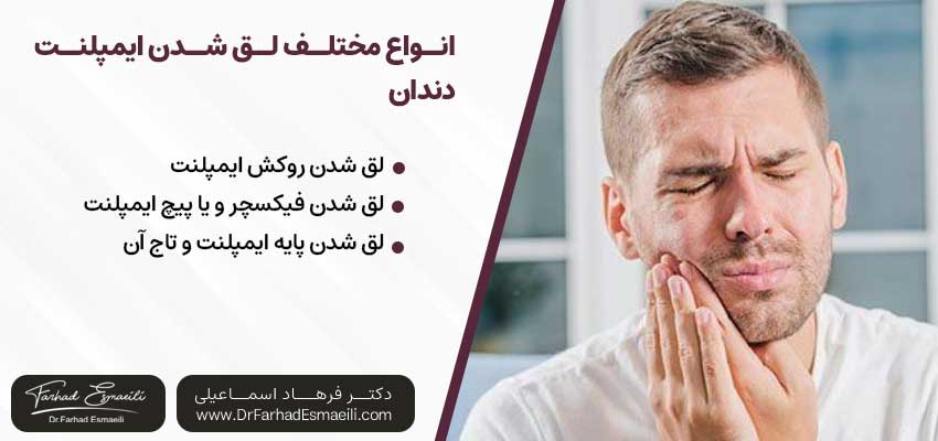 انواع مختلف لق شدن ایمپلنت دندان |دکتر آرش گلستانه جراح فک و صورت در اصفهان