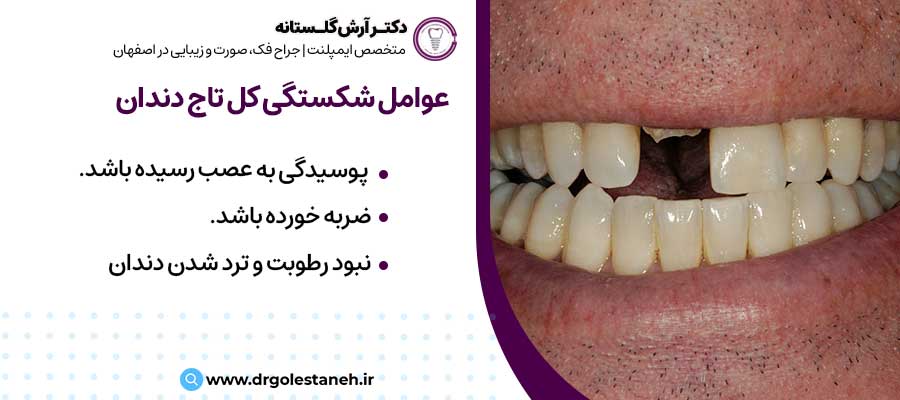 شکستگی کل تاج دندان |دکتر آرش گلستانه جراح فک و صورت در اصفهان 