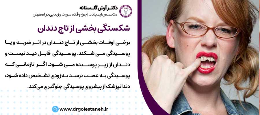 شکستگی بخشی از تاج دندان |دکتر آرش گلستانه جراح فک و صورت در اصفهان