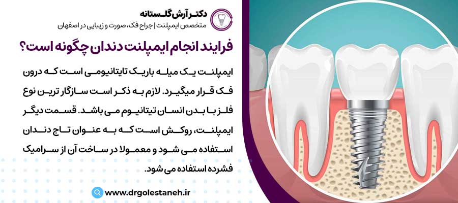 فرایند انجام ایمپلنت دندان چگونه است؟ |دکتر آرش گلستانه جراح فک و صورت در اصفهان 