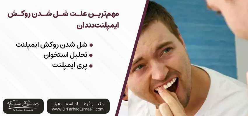 مهم‌ترین علت شل‌ شدن روکش ایمپلنت دندان |دکتر آرش گلستانه جراح فک و صورت در اصفهان