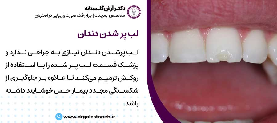 لب پرشدن دندان |دکتر آرش گلستانه جراح فک و صورت در اصفهان 