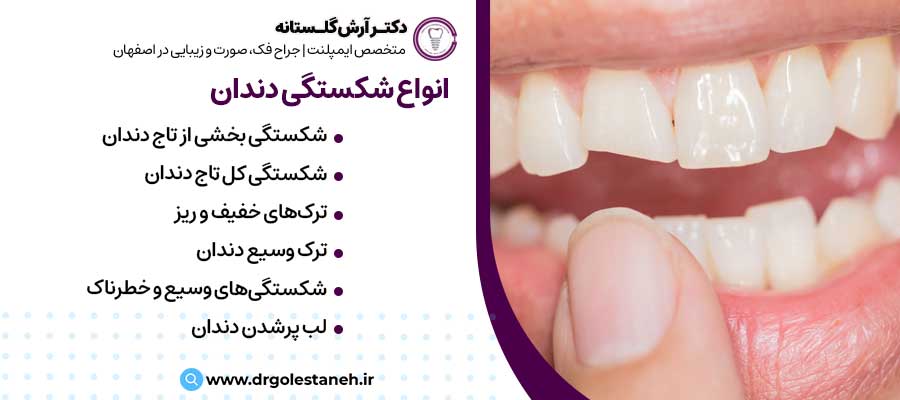 انواع شکستگی دندان |دکتر آرش گلستانه جراح فک و صورت در اصفهان