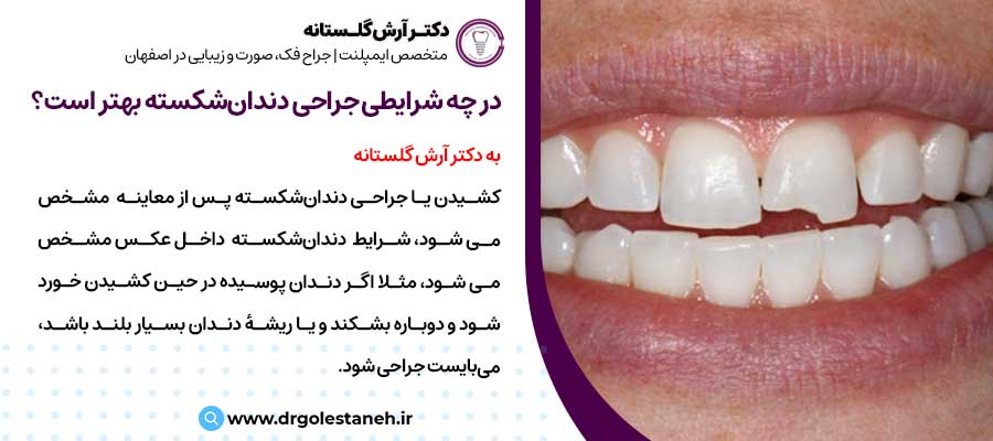 در چه شرایطی جراحی دندان‌شکسته بهتراست؟ |دکتر آرش گلستانه جراح فک و صورت در اصفهان 