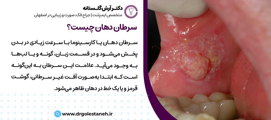 سرطان دهان چیست؟ |دکتر آرش گلستانه جراح فک و صورت در اصفهان