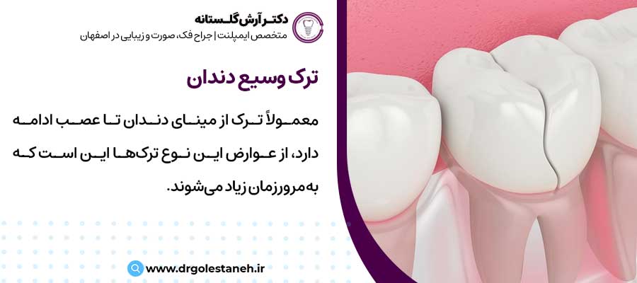 ترک وسیع دندان |دکتر آرش گلستانه جراح فک و صورت در اصفهان 