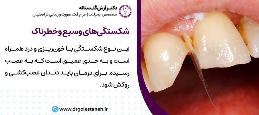 شکستگی وسیع دندان |دکتر آرش گلستانه جراح فک و صورت در اصفهان 