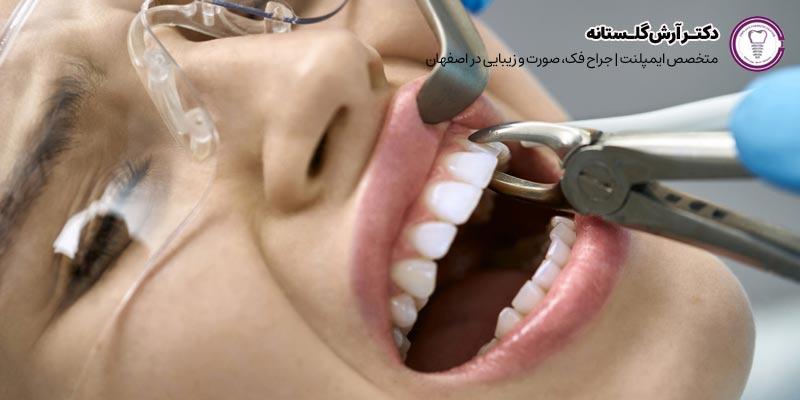 جراحی و کشیدن دندان شکسته + قیمت | دکتر آرش گلستانه جراح فک و صورت در اصفهان