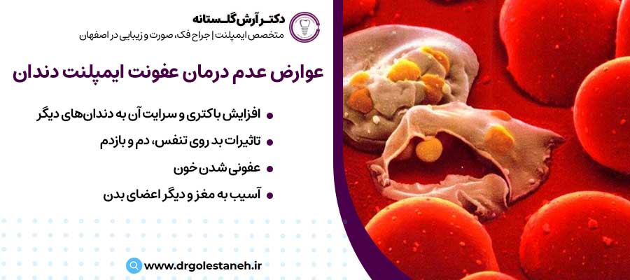 عوارض عدم درمان عفونت ایمپلنت دندان |دکتر آرش گلستانه جراح فک و صورت در اصفهان
