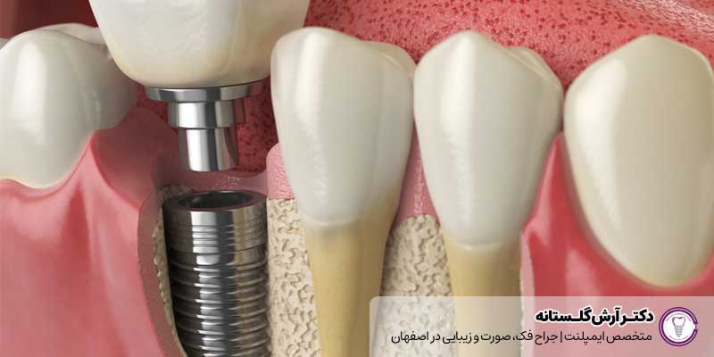 برداشتن ایمپلنت دندان |دکتر آرش گلستانه جراح فک و صورت در اصفهان