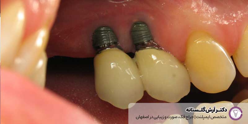 عفونت پیچ ایمپلنت دندان |دکتر آرش گلستانه جراح فک و صورت در اصفهان 