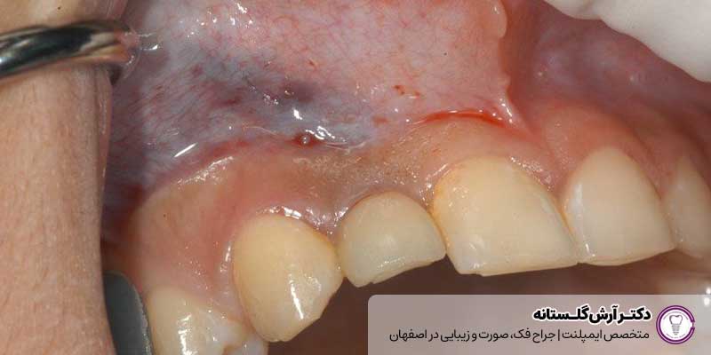 عکس عفونت ایمپلنت |دکتر آرش گلستانه جراح فک و صورت در اصفهان