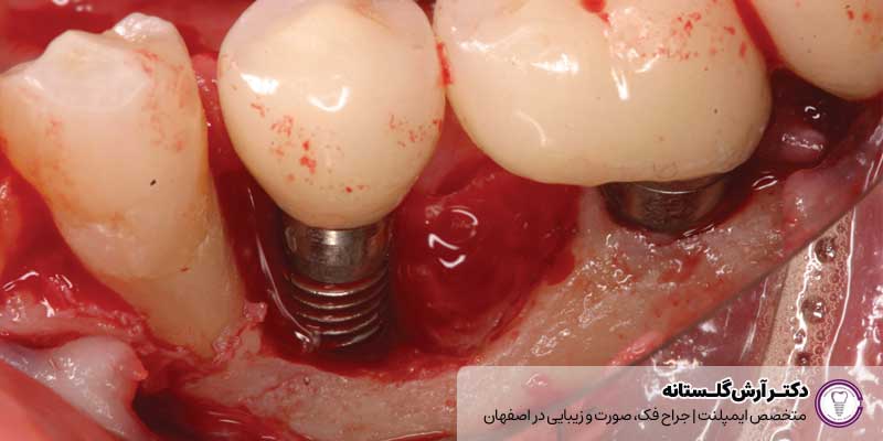 عکس عفونت ایمپلنت |دکتر آرش گلستانه جراح فک و صورت در اصفهان