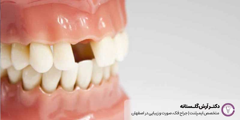 آیا می‌توان از مینی ایمپلنت برای دندان مصنوعی ردیف بالا استفاده کرد؟