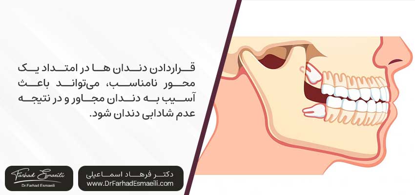 آسیب ایمپلنت به دندان های مجاور
