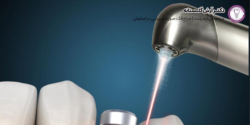 ایمپلنت با لیزر | روشی نو و جدید در عرصه دندانپزشکی