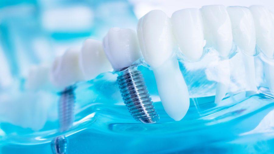 حفظ سلامت استخوان فک با ایمپلنت های دندانی | آینده انقلابی ایمپلنت های دندانی