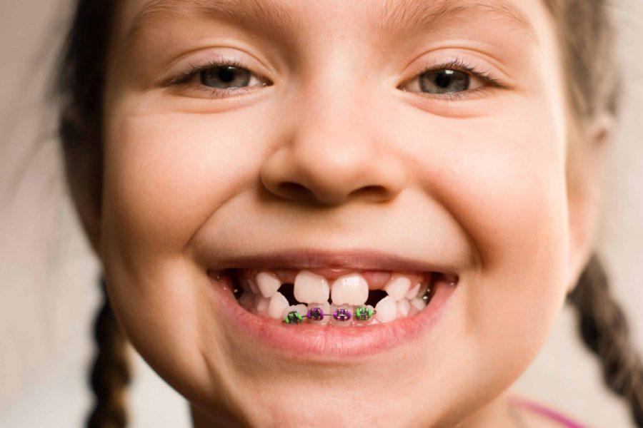 ارتودنسی بعد از افتادن دندان | مرکز ایمپلنت دکتر گلستانه