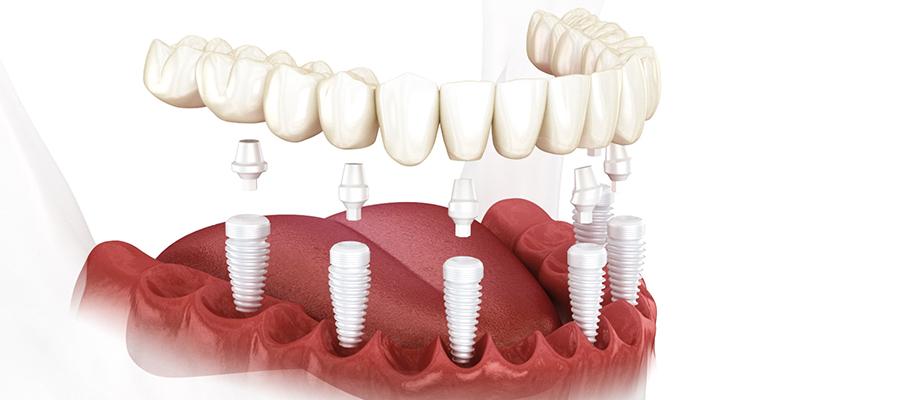 مزایای ایمپلنت زیرکونیا | مطب دندانپزشکی زیبایی دکتر آرش گلستانه