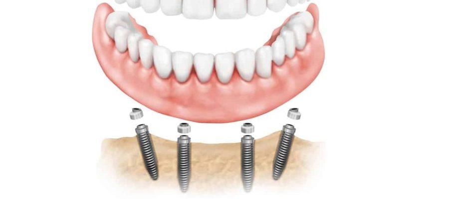 ایمپلنت‌های دندانی All-on-6 | ایمپلنت دکتر گلستانه