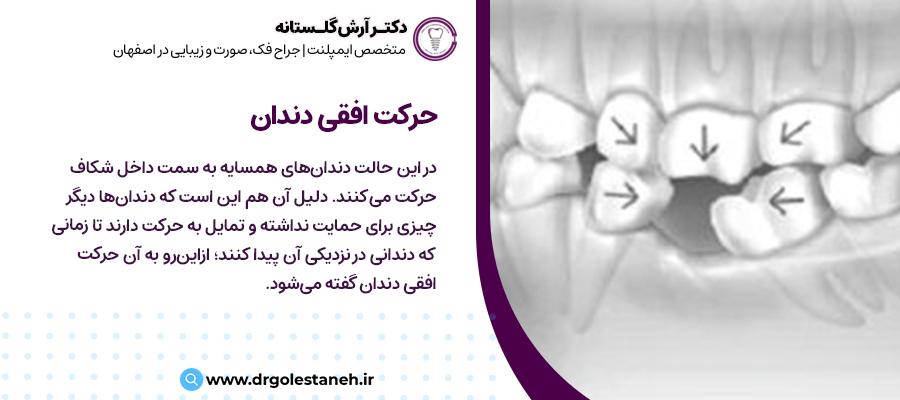 حرکت افقی دندان | مطب دکتر آرش گلستانه در اصفهان