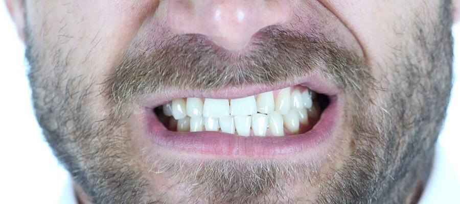 دندان قروچه | علل درد فک